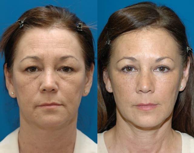 Eyelid Surgery (Blepharoplasty) procedure image