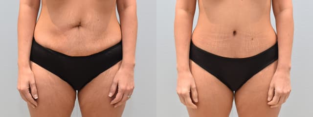 Tummy Tuck (Abdominoplasty) procedure image