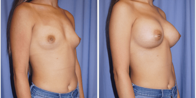 Breast Implants (Saline/Silicone) procedure image