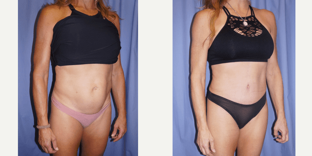 Tummy Tuck (Abdominoplasty) procedure image