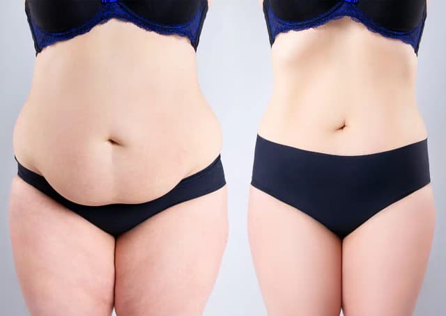 Tummy Tuck (Abdominoplasty) procedure image