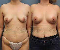 Breast Augmentation procedure image