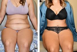 Mommy Makeover procedure image