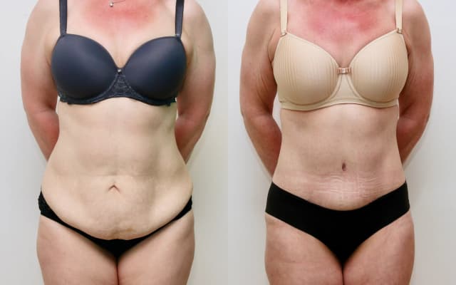 Mommy Makeover procedure image