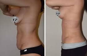 Tummy Tuck (Abdominoplasty) procedure image