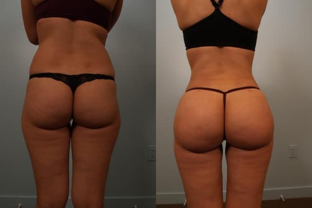Brazilian Butt Lift (BBL) procedure image