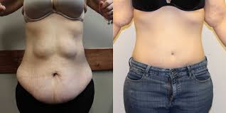 Tummy Tuck (Abdominoplasty) procedure image