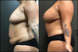 Mommy Makeover procedure image