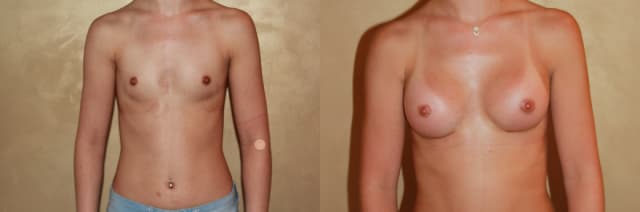Breast Augmentation procedure image