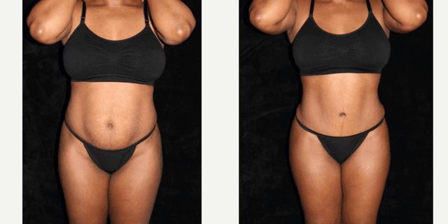 Tummy Tuck (Abdominoplasty) procedure image