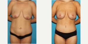 Mommy Makeover procedure image