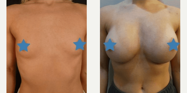 Breast Augmentation procedure image