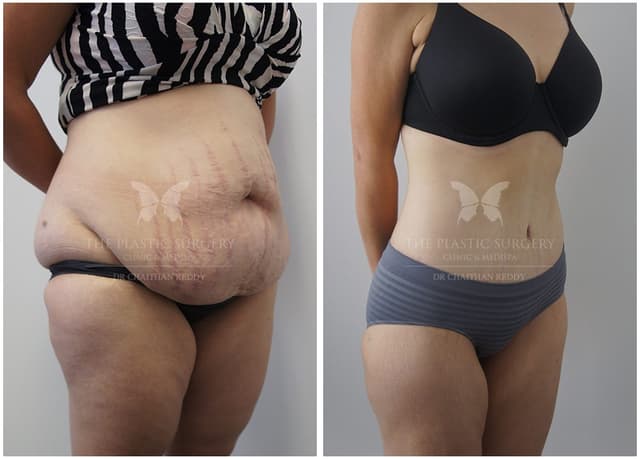 Mommy Makeover procedure image