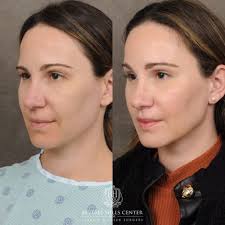 Skin Tightening procedure image