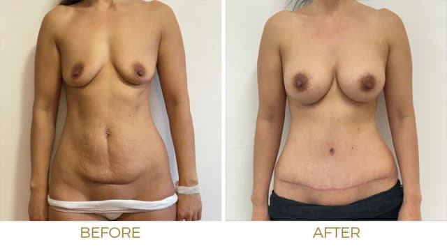 Mommy Makeover procedure image