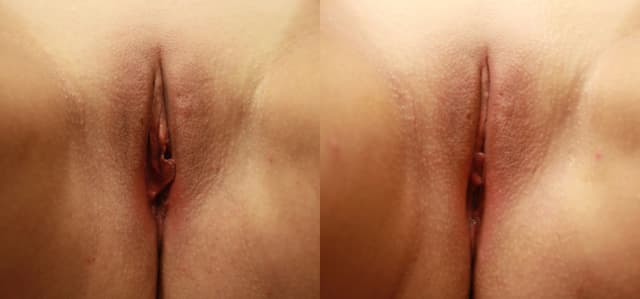 Vaginal Rejuvenation procedure image