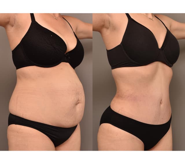 Tummy Tuck (Abdominoplasty) procedure image