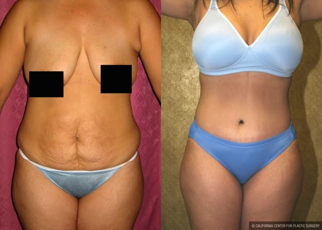 Mommy Makeover procedure image