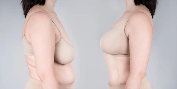 Breast Augmentation with Lift procedure image