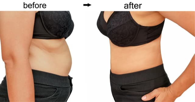Liposuction procedure image