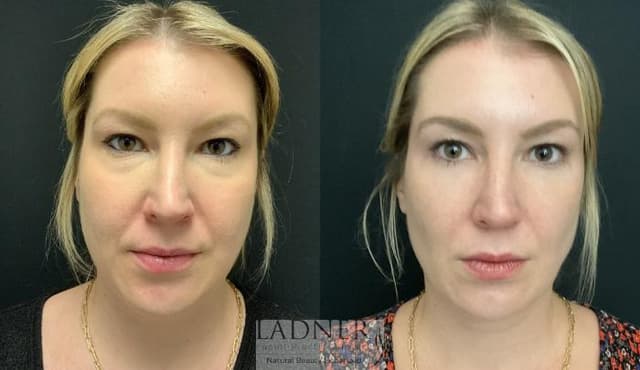 Eyelid Surgery (Blepharoplasty) procedure image