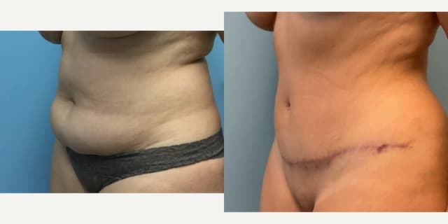 Skin Tightening procedure image