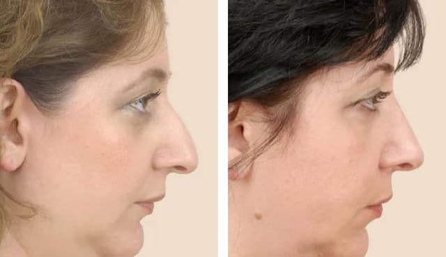 Rhinoplasty (Nose Job) procedure image