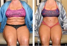 Mommy Makeover procedure image