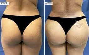 Hip Enhancement procedure image