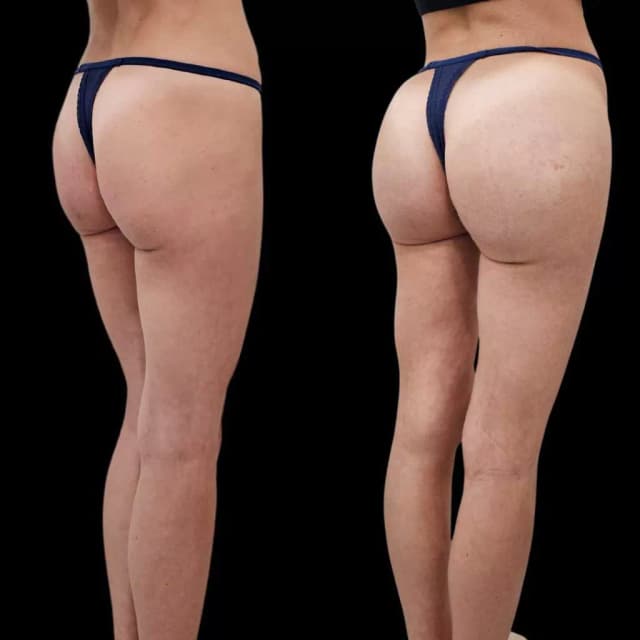 Brazilian Butt Lift (BBL) procedure image
