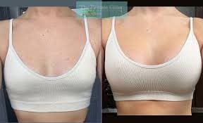 Breast Augmentation procedure image