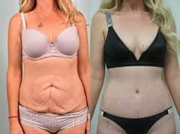 Tummy Tuck (Abdominoplasty) procedure image