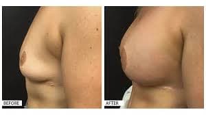 Breast Augmentation procedure image