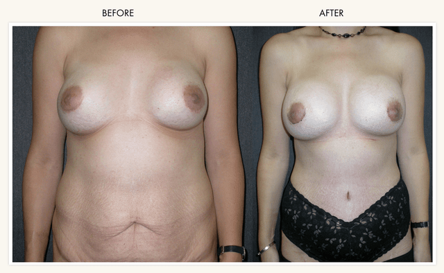 Mommy Makeover procedure image