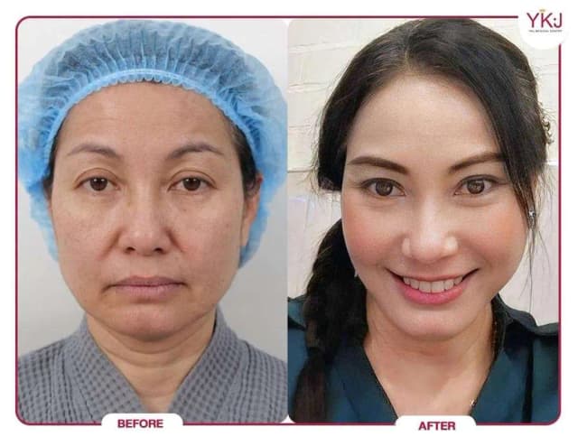 Facelift procedure image