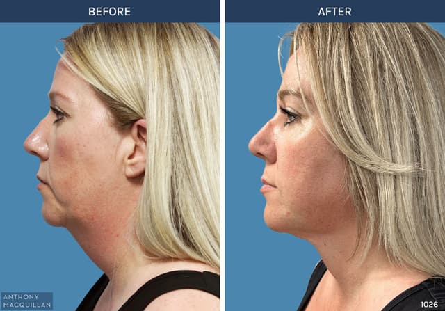 Neck Lift procedure image