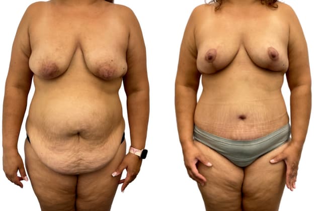 Skin Tightening procedure image