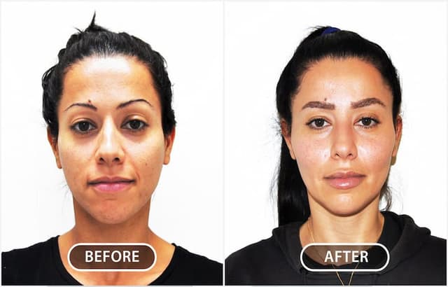Cheek Enhancement procedure image