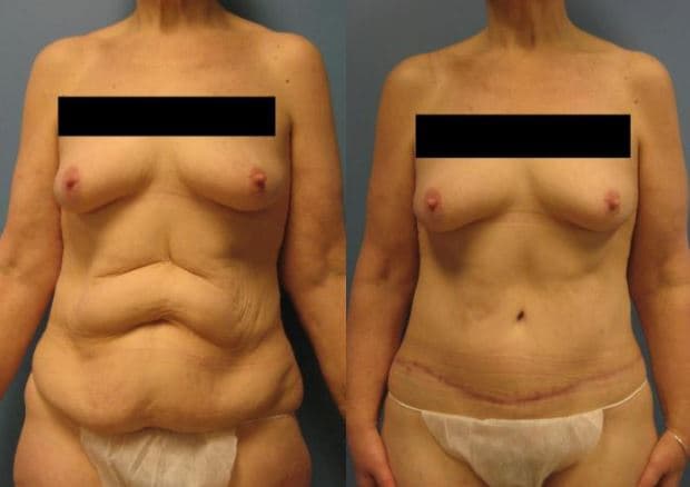 Mommy Makeover procedure image