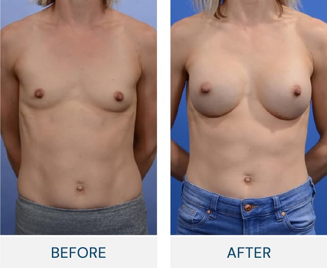 Breast Augmentation procedure image