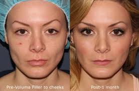 Fillers & Injectables (e.g. Botox, Juvederm) procedure image