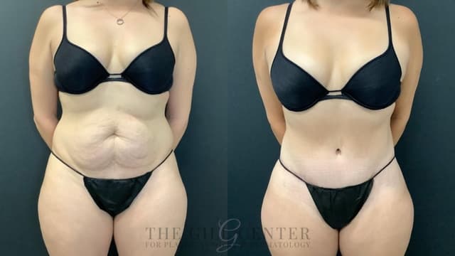 Tummy Tuck (Abdominoplasty) procedure image