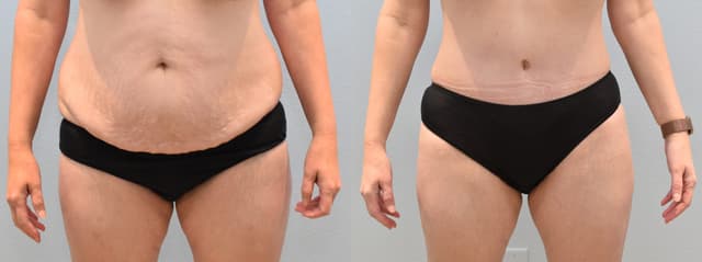 Mommy Makeover procedure image