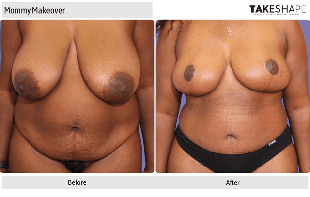 Breast Augmentation procedure image