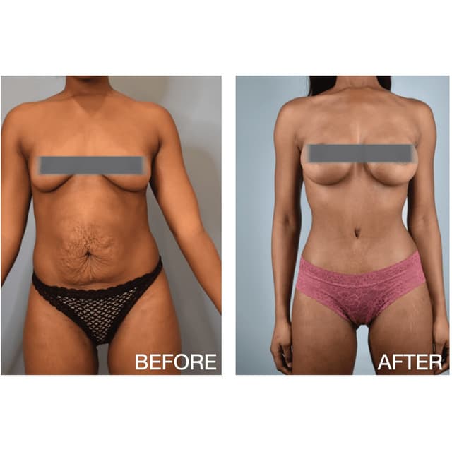 Mommy Makeover procedure image