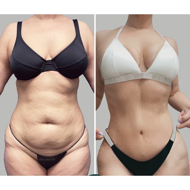 Tummy Tuck (Abdominoplasty) procedure image