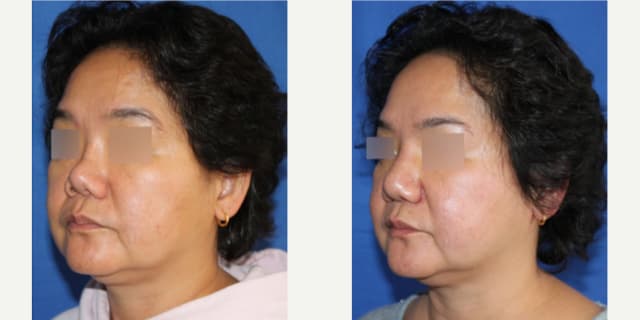 Lip Reduction procedure image