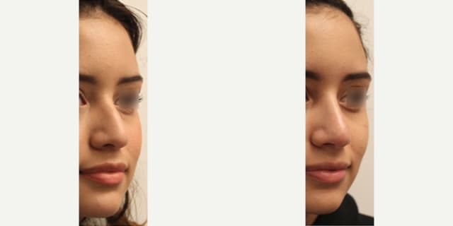 Rhinoplasty (Nose Job) procedure image