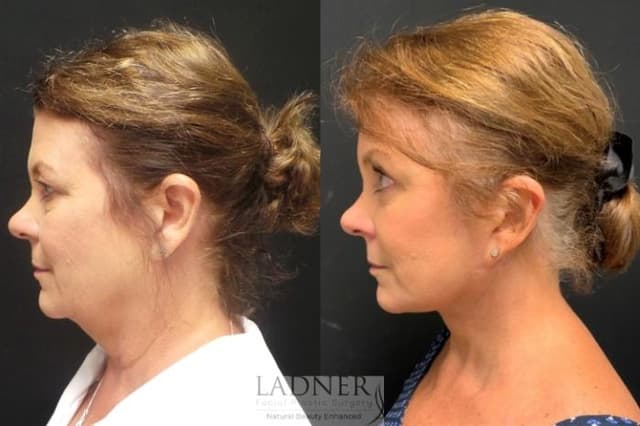 Neck Lift procedure image