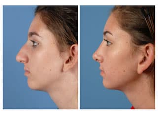 Rhinoplasty (Nose Job) procedure image